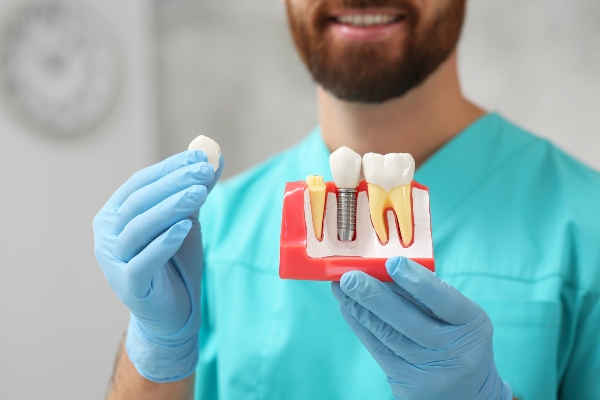 Dental Implant Crown Placement FAQs
