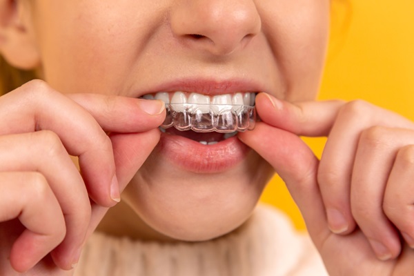 How To Find The Best Invisalign Dentist For A Perfectly Aligned Smile